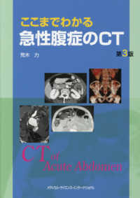 ここまでわかる急性腹症のCT