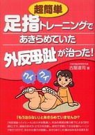 超簡単足指トレーニングであきらめていた外反母趾が治った!